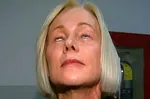 67-летняя женщина не могла закрыть глаз после неудачной подтяжки лица: шокирующие результаты после 4-часовой операции