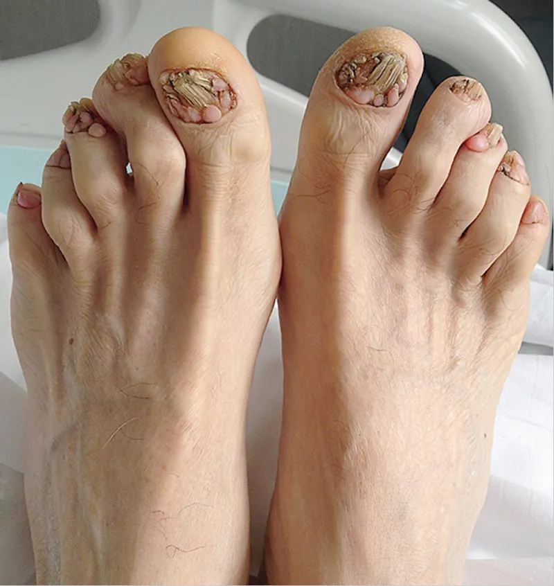 Чтобы вылечить тяжелое грибковое заболевание, мужчине удалили семь ногтей на ногах
